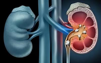Kidney Stone Removal